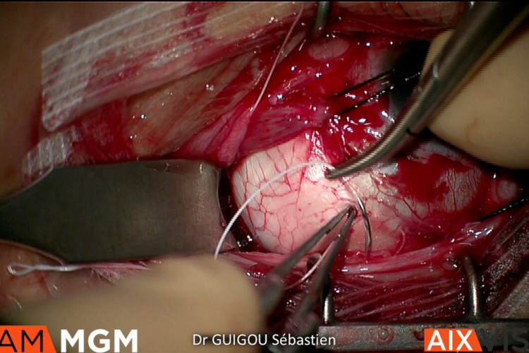 Décollement de rétine externe