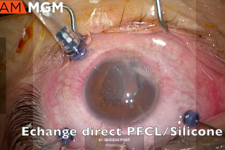 Décollement de rétine complexe