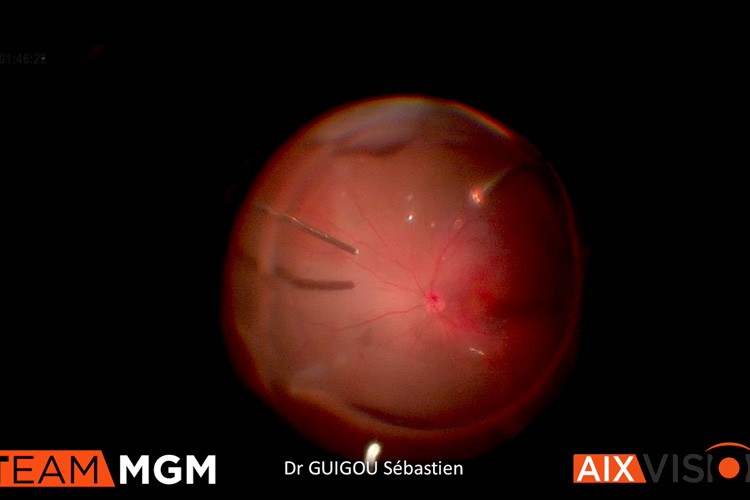 Sub retinal hemorrhage