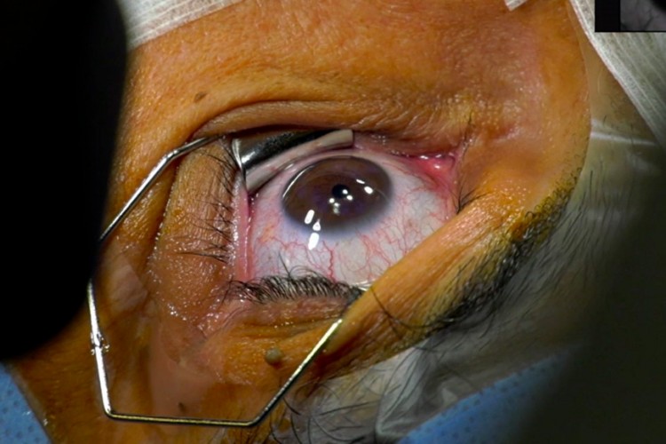 Real Surgery - Laser réfractif