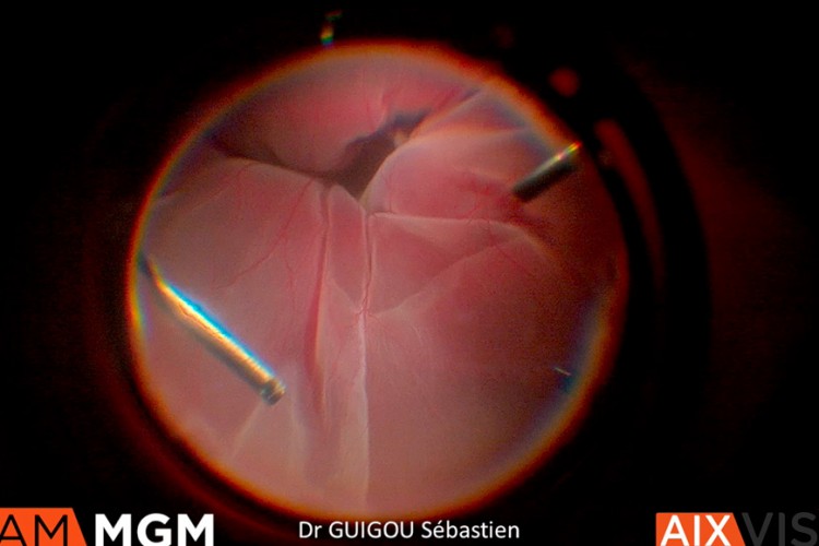 Hématome sous rétinien massif