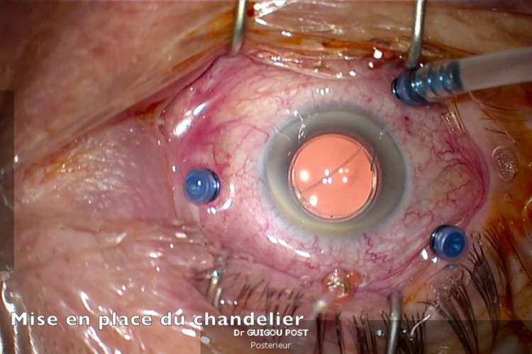 Décollement de rétine simple