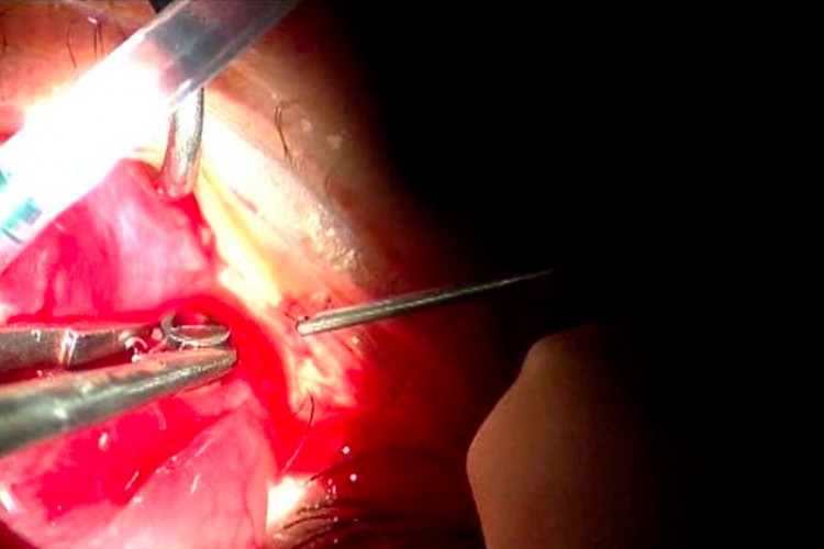 Hématome choroidien drainage 23G