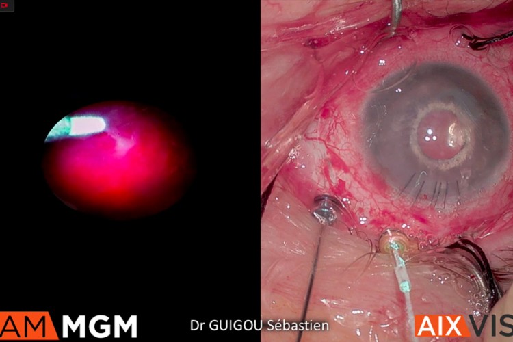 Décollement de rétine sous endoscopie