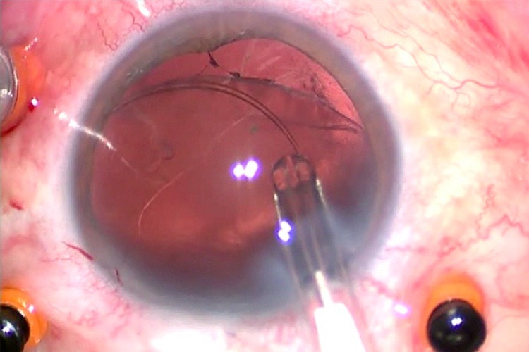 Laxité zonulaire étendue anneau sac préchargé