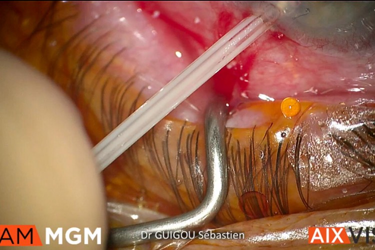 Ablation Ozurdex luxé en chambre antérieure, catheter