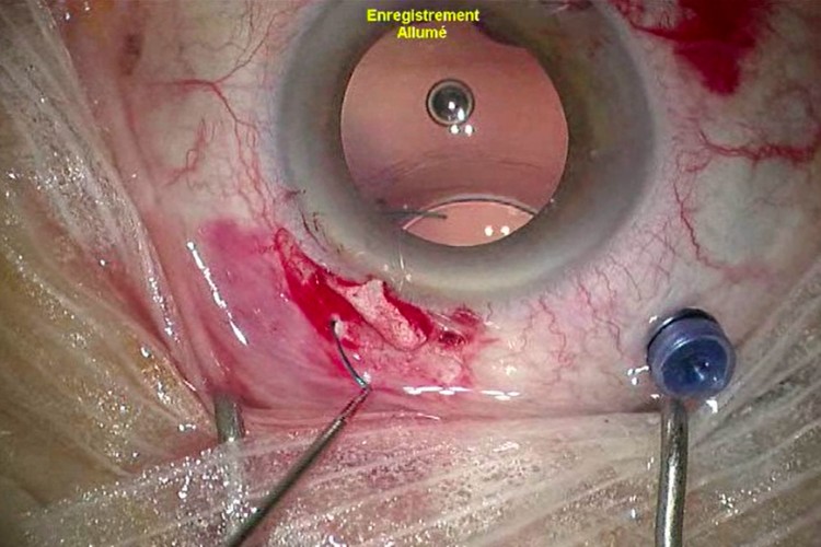 IOL luxé 3 pièces suture sclère