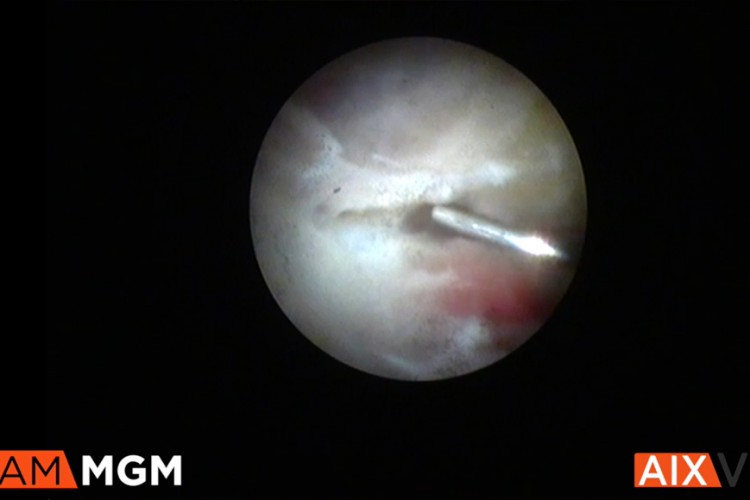 Endophtalmie avec vitrectomie assistée par endoscopie