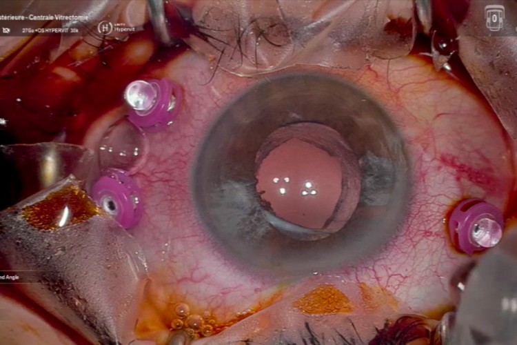 Real Surgery - Traction vitréo maculaire