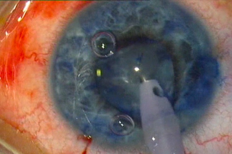 Cataracte rupture capsulaire bimanuel iol sulcus et anneau sac