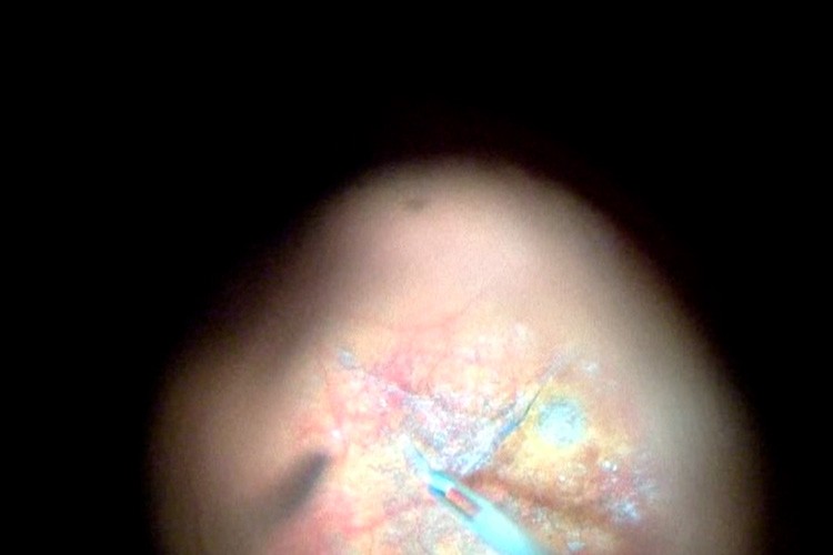 Trou maculaire myope ablation d’un cil