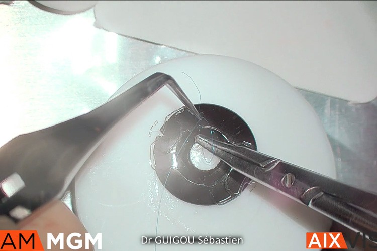 Iris artificiel complexe