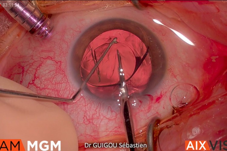 Explantation IOL Pac man 1