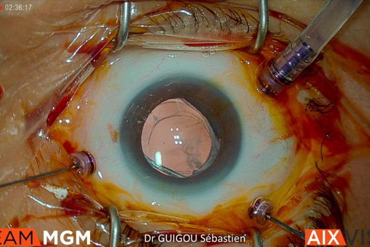 Vitrectomie pour ablation de corps flottant