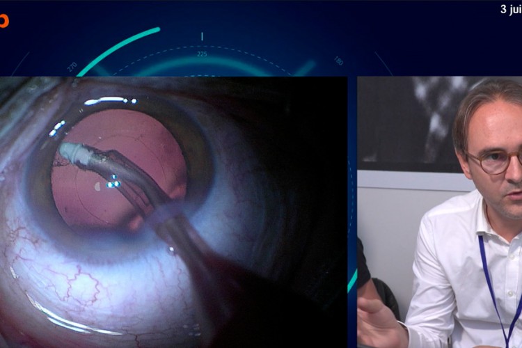 Real Surgery, cataracte et IOL à profondeur de champ