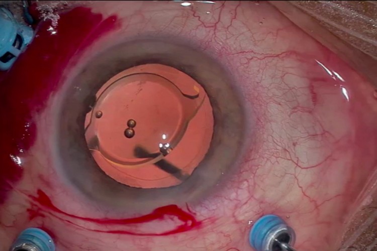 Real Surgery - Combinée cataracte et membrane épirétinienne
