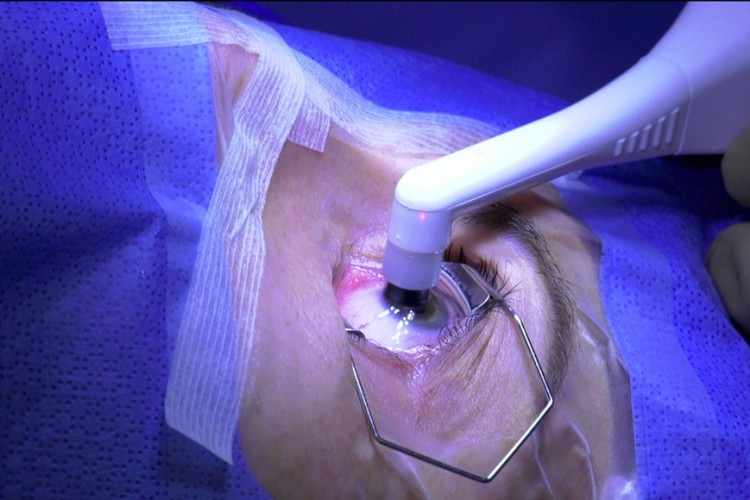 Real Surgery - PRK Myopie