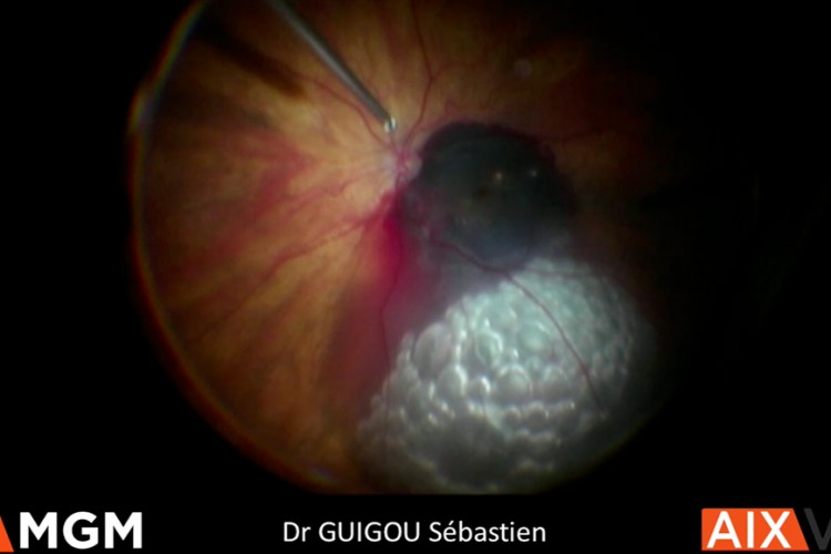 Hématome maculaire vitrectomie déplacement pneumatique