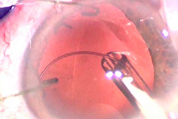 Cataracte traumatique crochet anneau de sac iridoplastie de Siepser