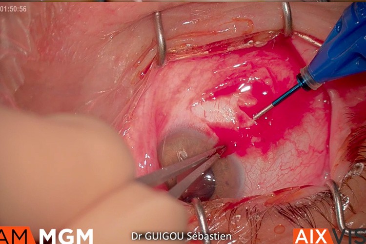 Luxation implant vitrectomie Carlevale