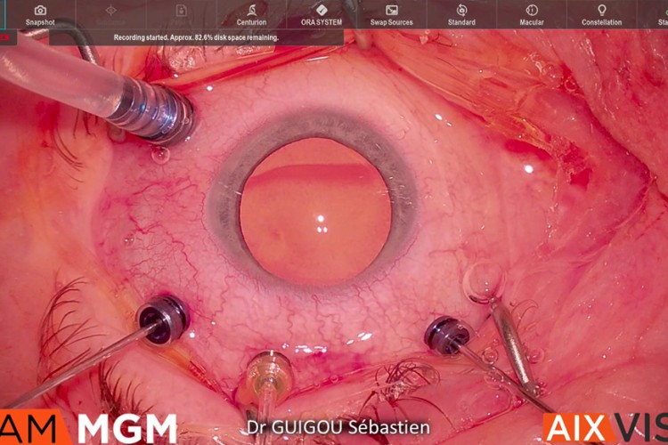 Fossette colobomateuse avec patch de membrane amniotique