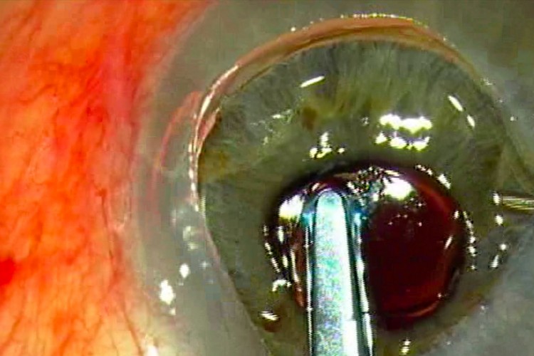 Greffe cornée explantation IOL clippé iris postérieur