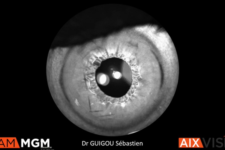 Cataracte et trou lamellaire