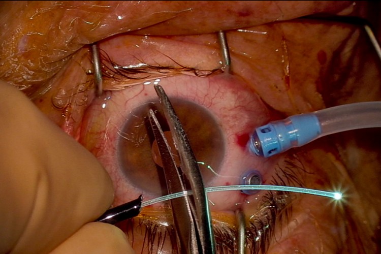 Real Surgery - Chirurgie d’une traction vitréo maculaire