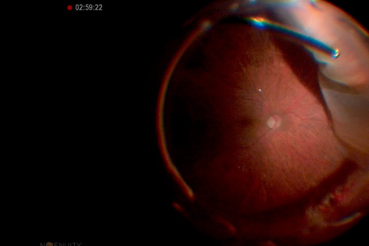 Décollement de rétine chandelier indentation bimanuelle