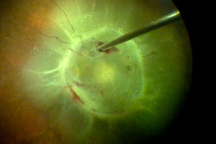 Rétinopathie diabétique proliférante compliquée de DR