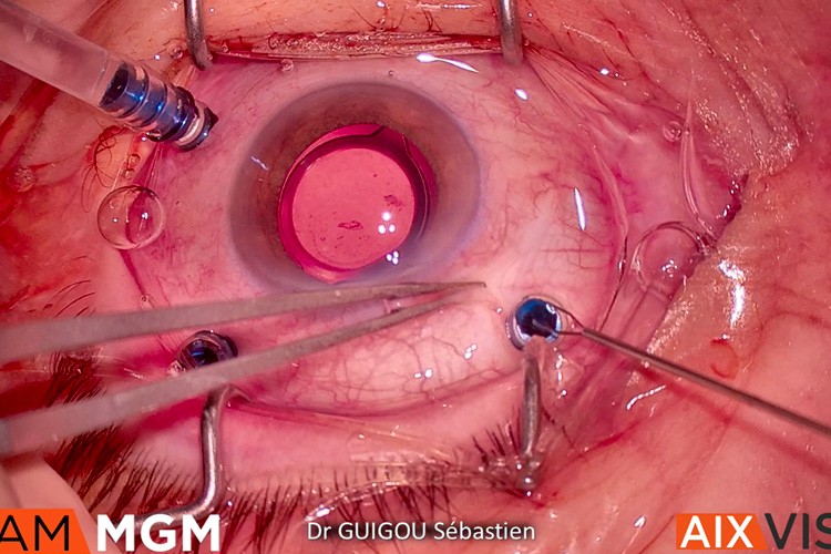 Trou maculaire patch membrane amniotique