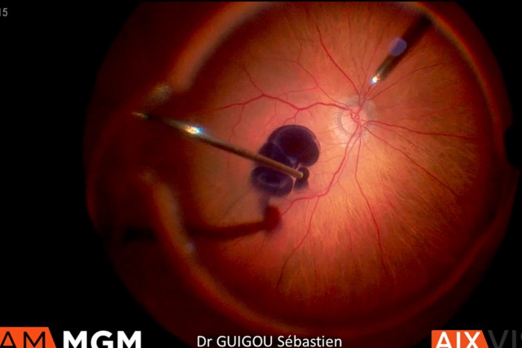 Trou maculaire simple