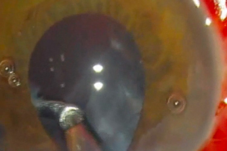 Cataracte compliquée de rupture capsulaire IOL clippé iris postérieur