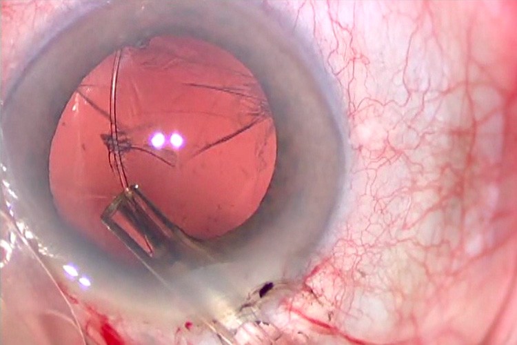 Laxité zonulaire 6h anneau sac