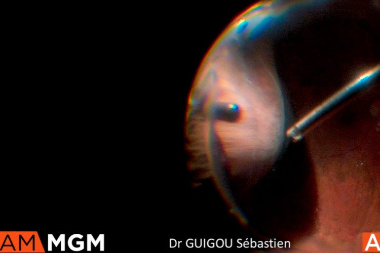 Décollement de rétine cryothérapie gaz