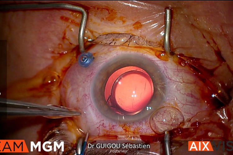 Membrane épirétinienne