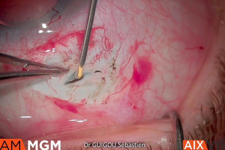 Iluvien supra choroidien