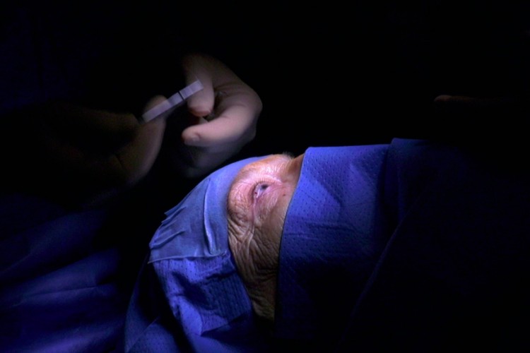 Real Surgery - Rétraction de paupière supérieure