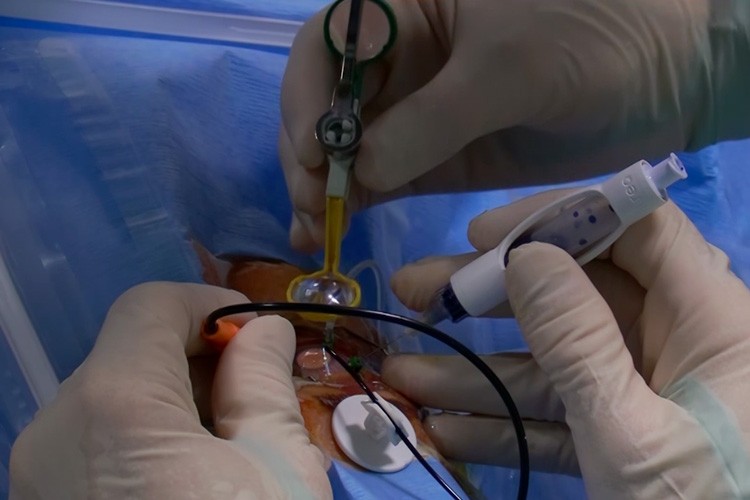 Trou maculaire Floretina live surgery