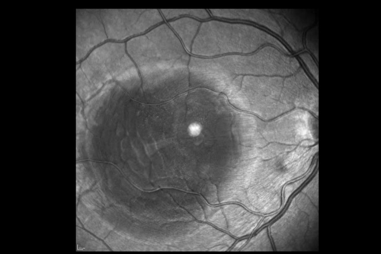 Hématome maculaire aiguille biseautée De Juan