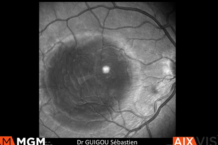 Hématome maculaire astuces