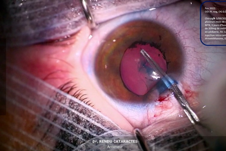 Si j’avais su - Uvéite pédiatrique