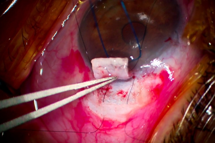 Real Surgery - Trabéculectomie