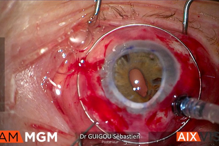 Greffe cornée Carlevale