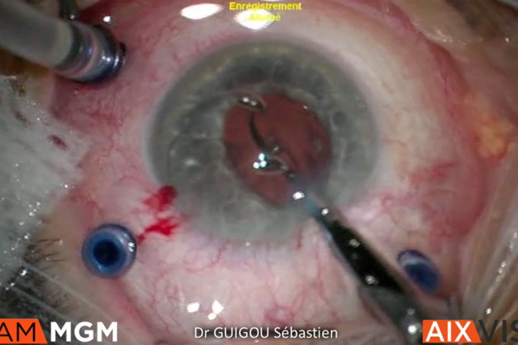Cataracte rupture capsulaire explantation