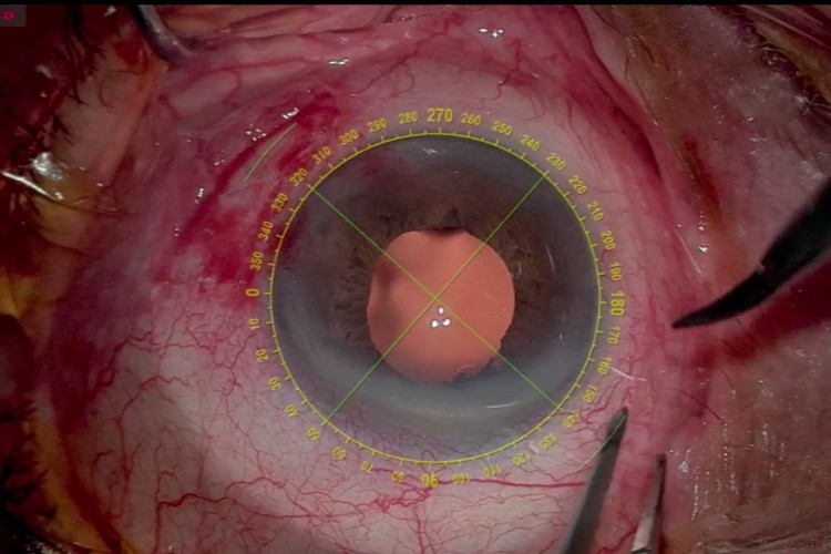 Real Surgery - Implantation secondaire implant Carlevale