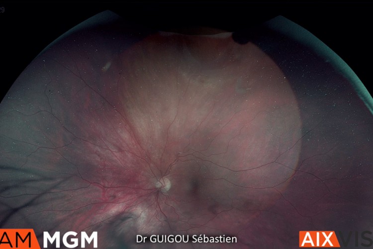 Décollement de rétine cryo visco indentation