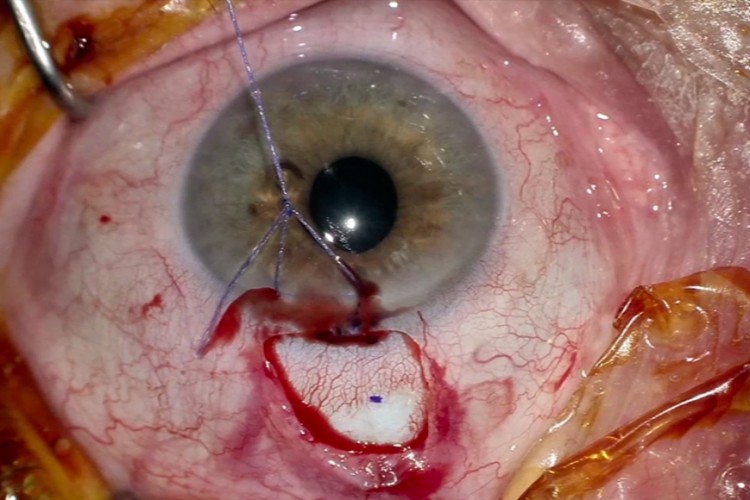 Real Surgery - Glaucome secondaire Preserflo Santen – Zeiss Artevo 850
