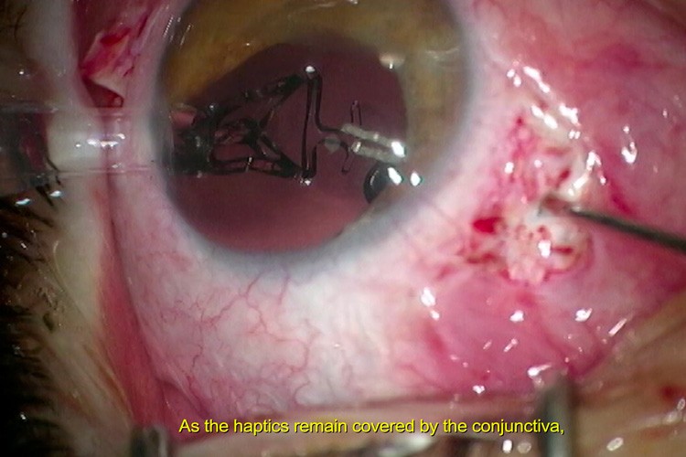 Plaie du globe vitrectomie Carlevale