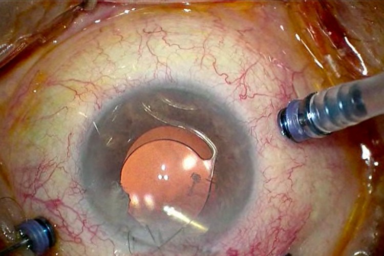 Explantation ICA IOL clippé iris iridoplastie McCannel